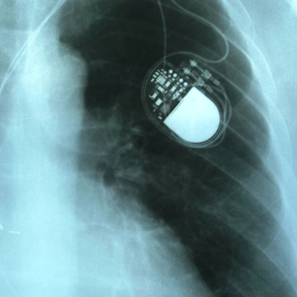 Pacemaker Xray